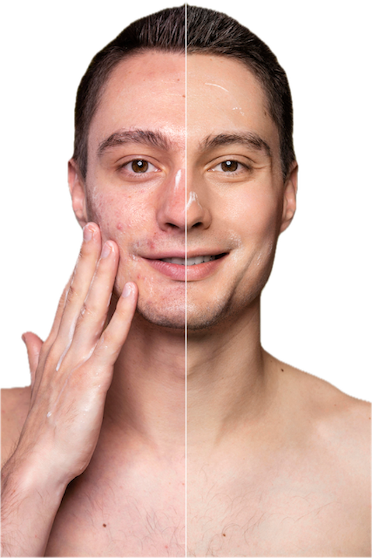 CREMĂ FĂCUTĂ MANUAL PENTRU TEN ACNEIC ȘI PROBLEMATIC, 40 ml